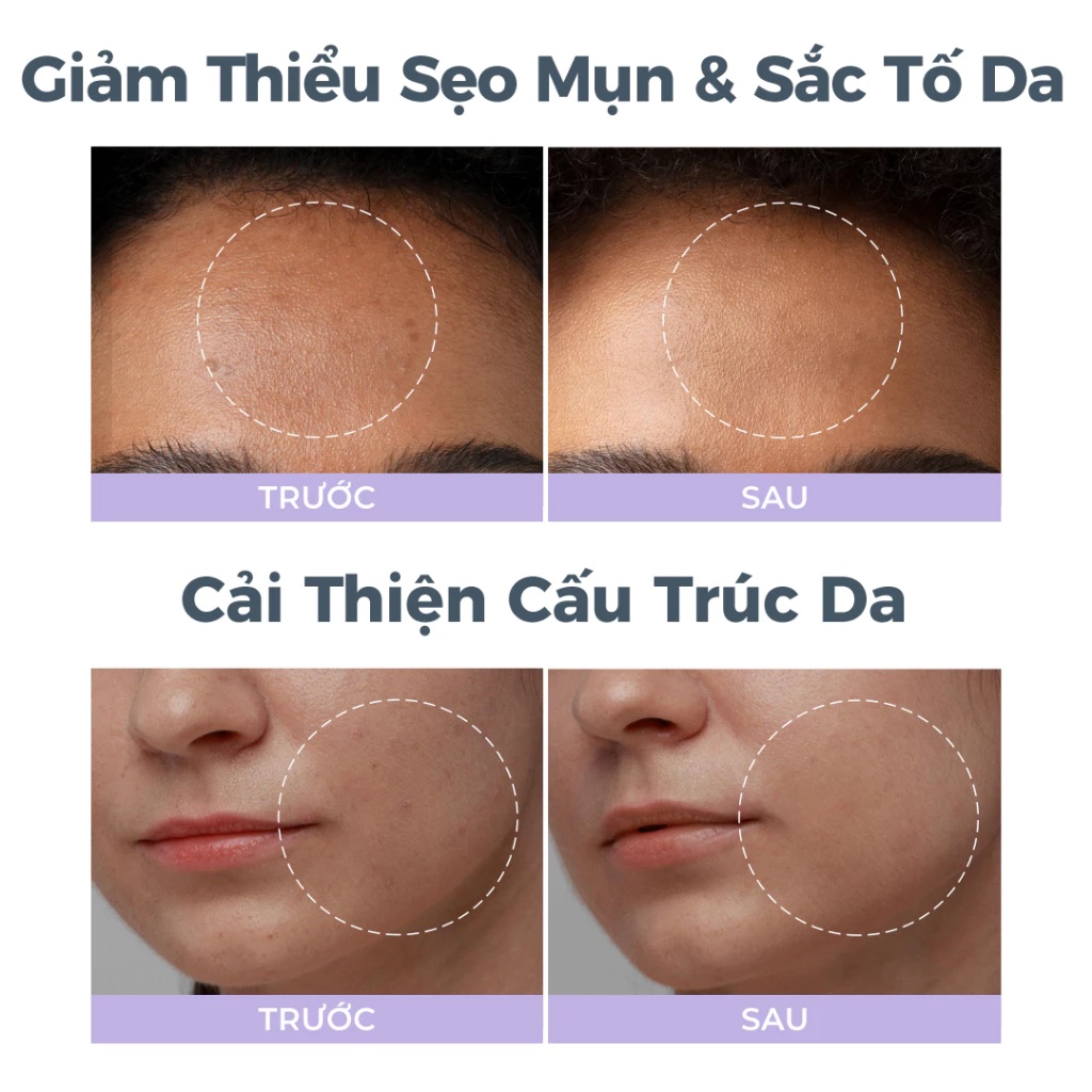 Máy mài da vi điểm, hút mụn Foreo KIWI Derma