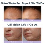 Máy mài da vi điểm, hút mụn Foreo KIWI Derma