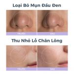 Máy mài da vi điểm, hút mụn Foreo KIWI Derma